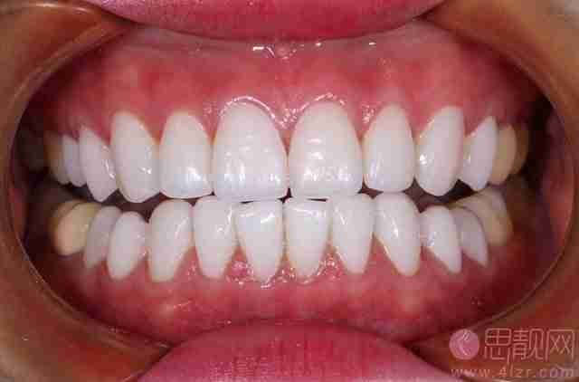 成都新桥口腔医院收费标准 牙齿美白真人案例分享