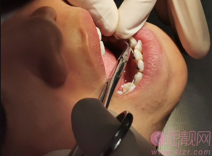 西安瑞泰口腔医院做牙齿矫正怎么样?矫正案例对比