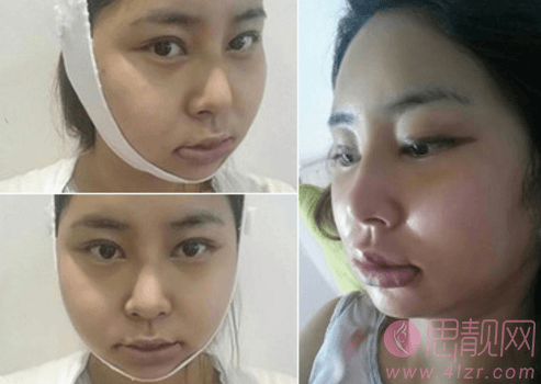 上海改脸型磨骨手术案例术后
