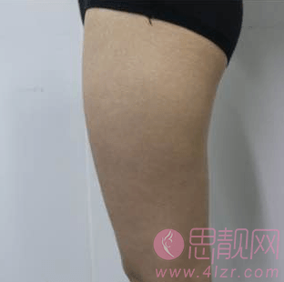 上海大小腿吸脂手术案例术前