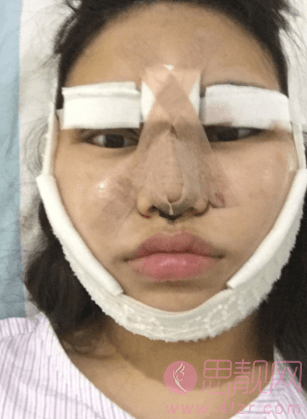 上海面部吸脂加隆鼻和双眼皮术后案例