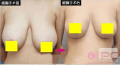 乳房缩小手术是什么？