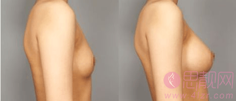 乳房松弛下垂可以用假体隆胸改良吗