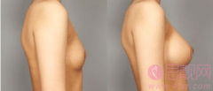 假体乳房再造是什么情况？