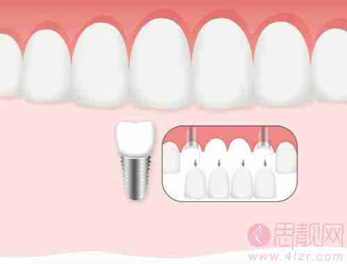 种植牙和镶牙的区别？ 