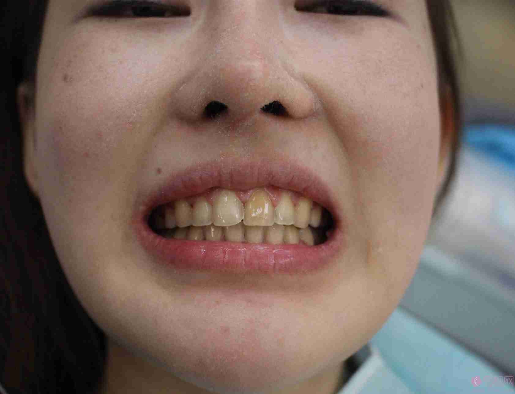 济南华侨医院口腔科美白牙齿多少钱？附案例就价格表一览