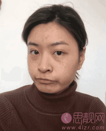 上海华山医院激光美容科祛斑怎么样？附祛斑术后果对比+2021价格表