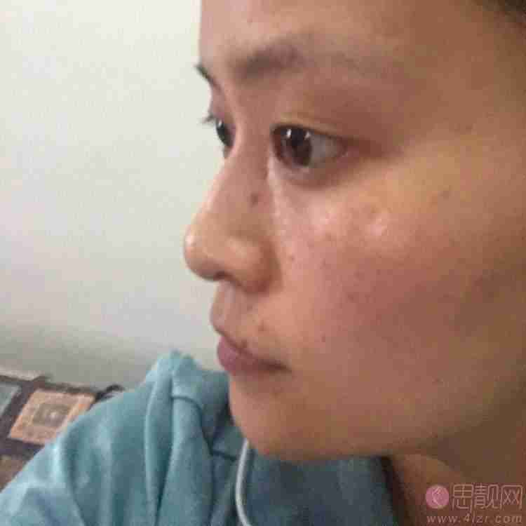 山东省省立医院激光美容科祛斑怎么样？附祛斑术前后果对比及2021价格表发布