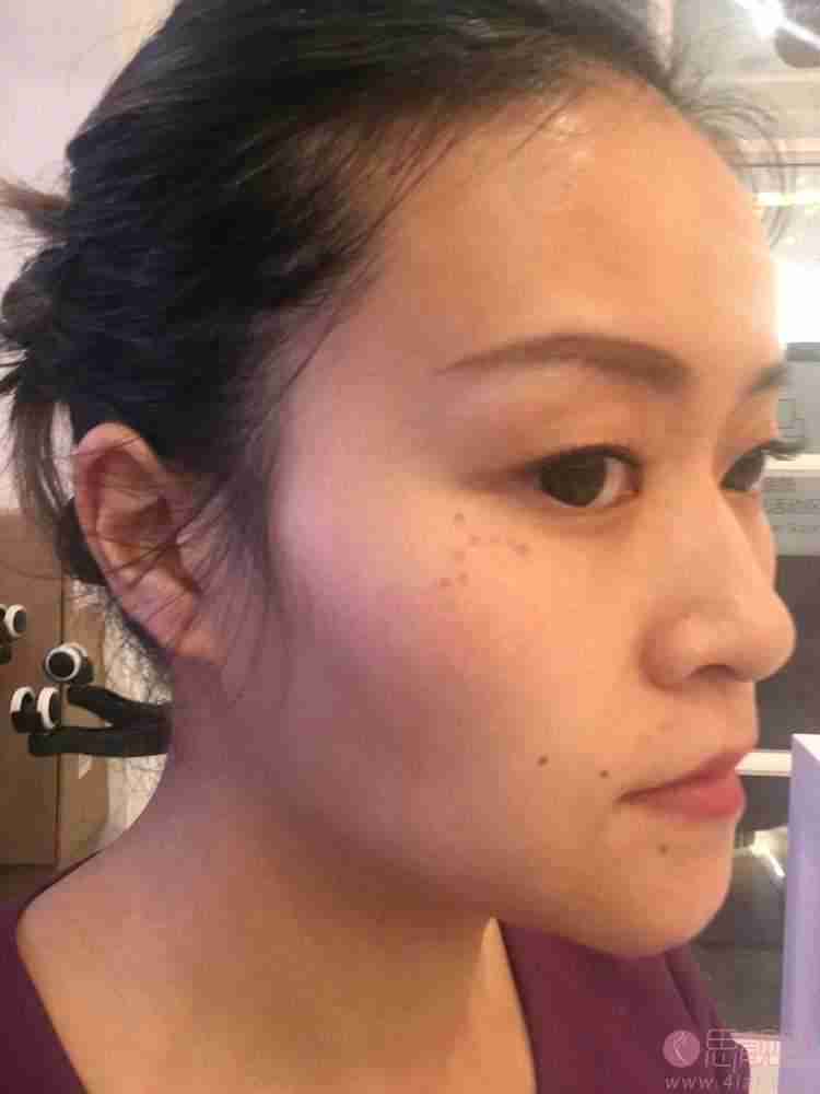 山东省省立医院激光美容科祛斑怎么样？附祛斑术前后果对比及2021价格表发布