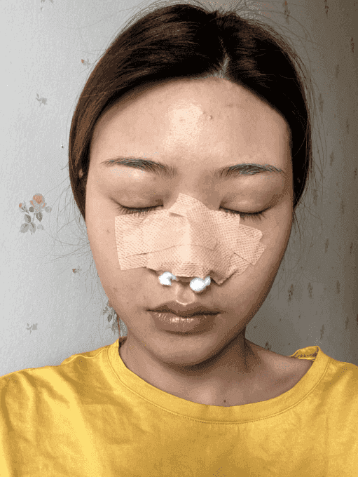 北京米扬丽格夏正义做的鼻部手术怎么样？附隆鼻案例及2021价格表上线
