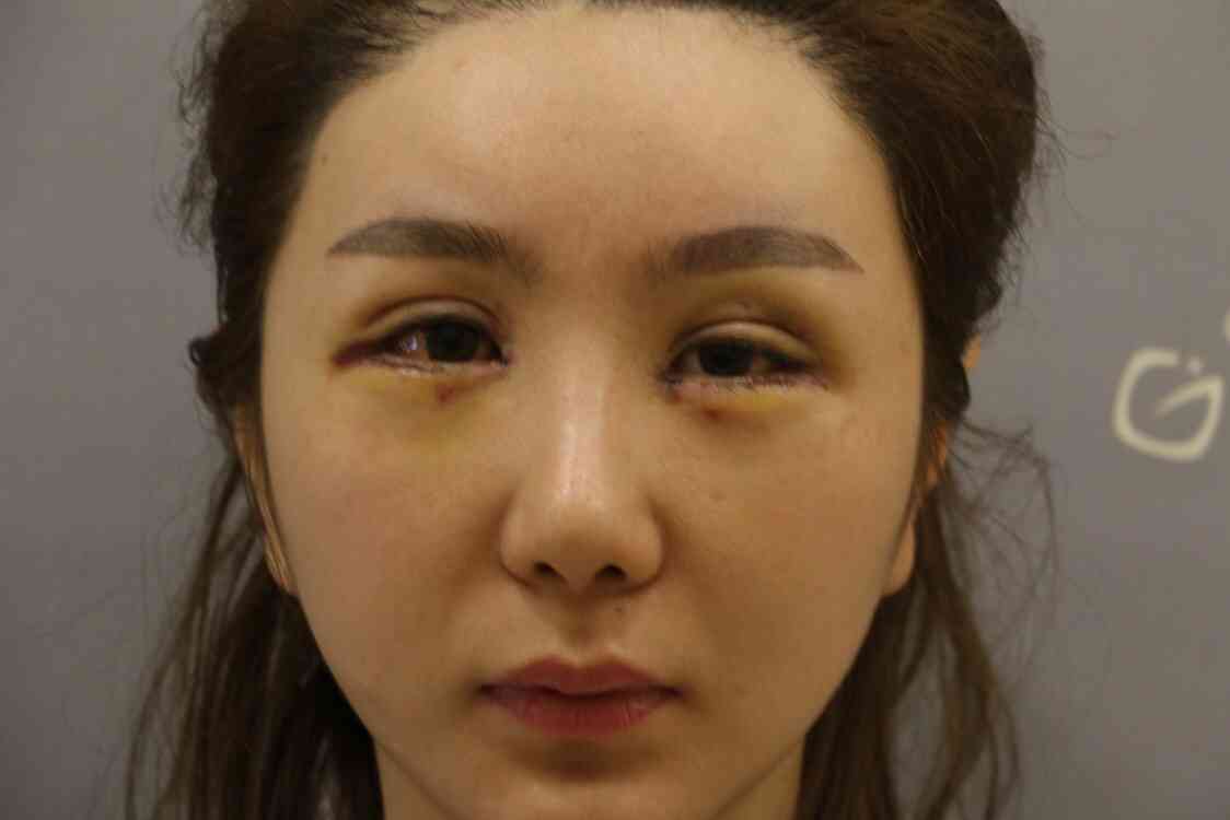 北京张冰洁修复双眼皮怎么样？附案例及2021价格表曝光