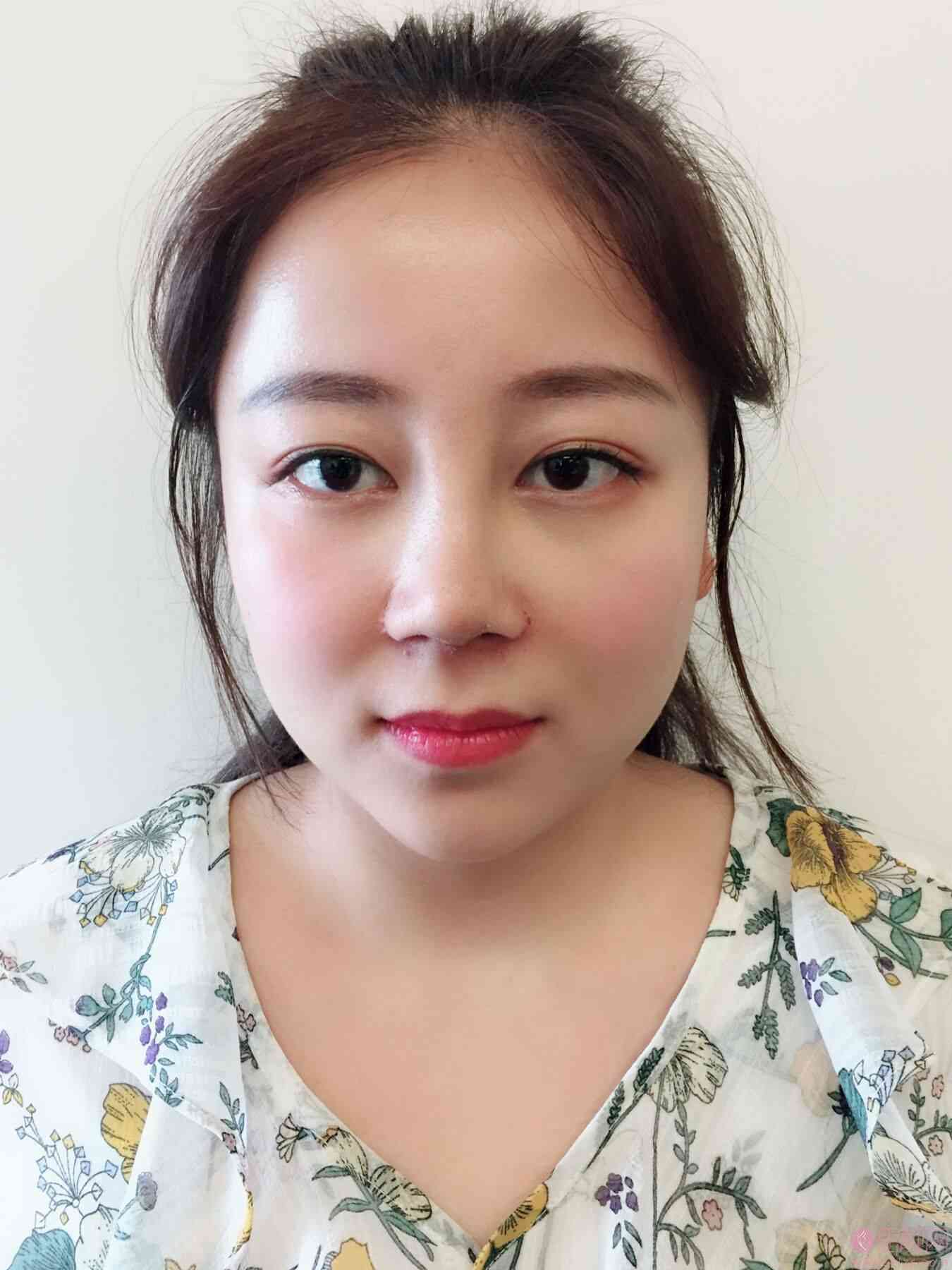 广州紫馨美医疗美容医院怎么样？附隆鼻案例及2021价格表公开