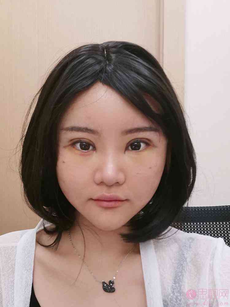 北京金燕子医疗美容诊所怎么样？双眼皮真人案例反馈+2021价格表一览