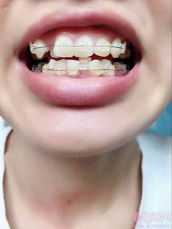 英博口腔是正规的牙科医院吗?附牙齿矫正案例及2021价格表