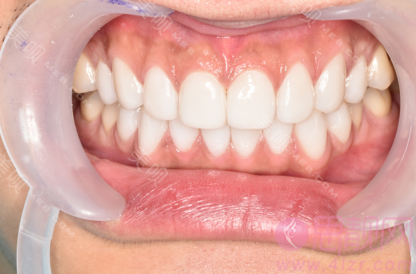成都极光口腔美白牙齿价格表一览+牙齿美白前后果对比一览