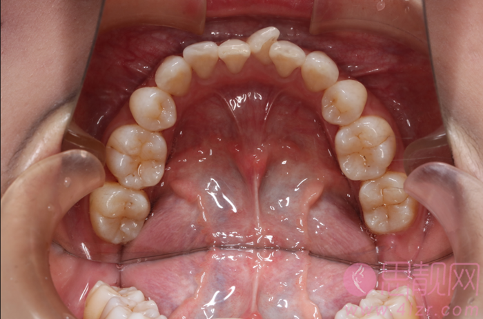 西安瑞泰口腔医院做牙齿矫正怎么样?矫正案例对比