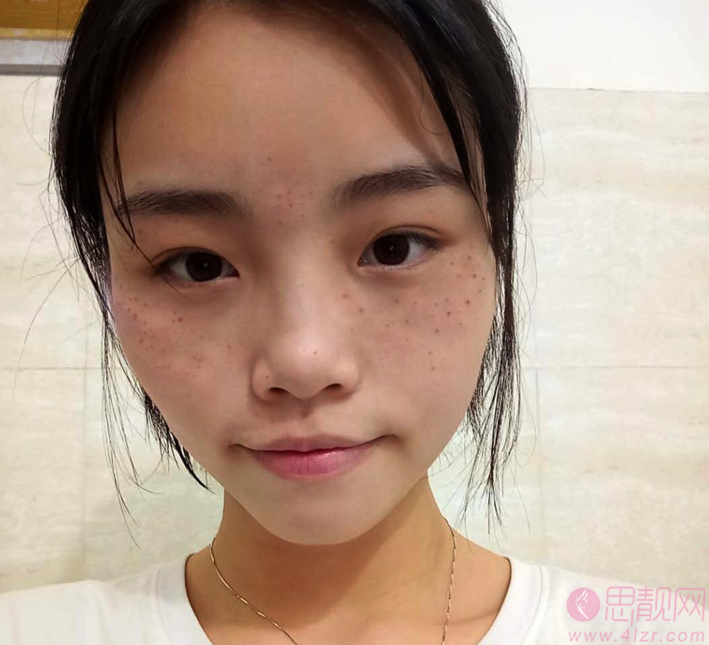 北京医院激光美容外科祛斑怎么样?附祛斑前后效果对比一览