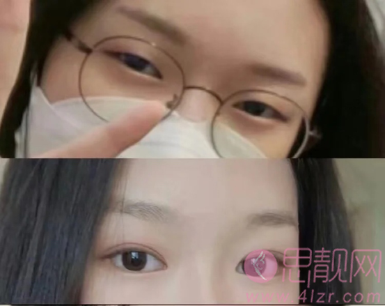 北京大学第三医院做双眼皮果好不好？