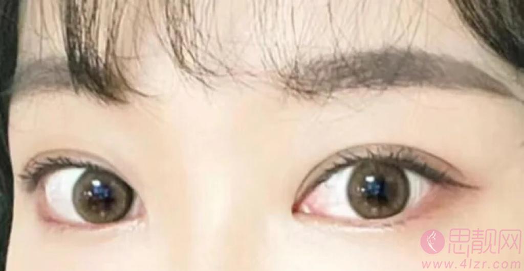 北京协和医院做双眼皮效果好不好？