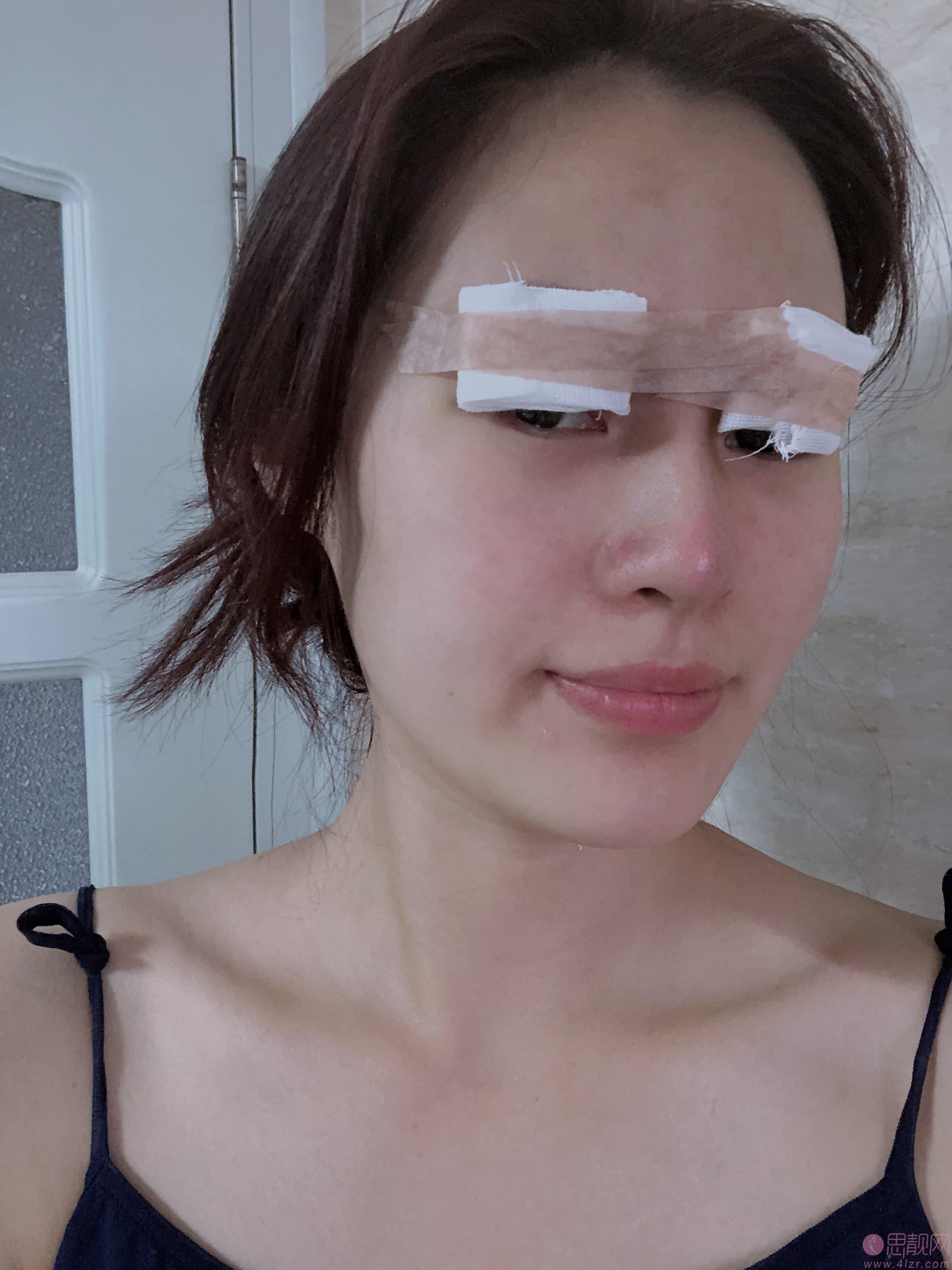 北京协和医院刘志飞做双眼皮怎么样？