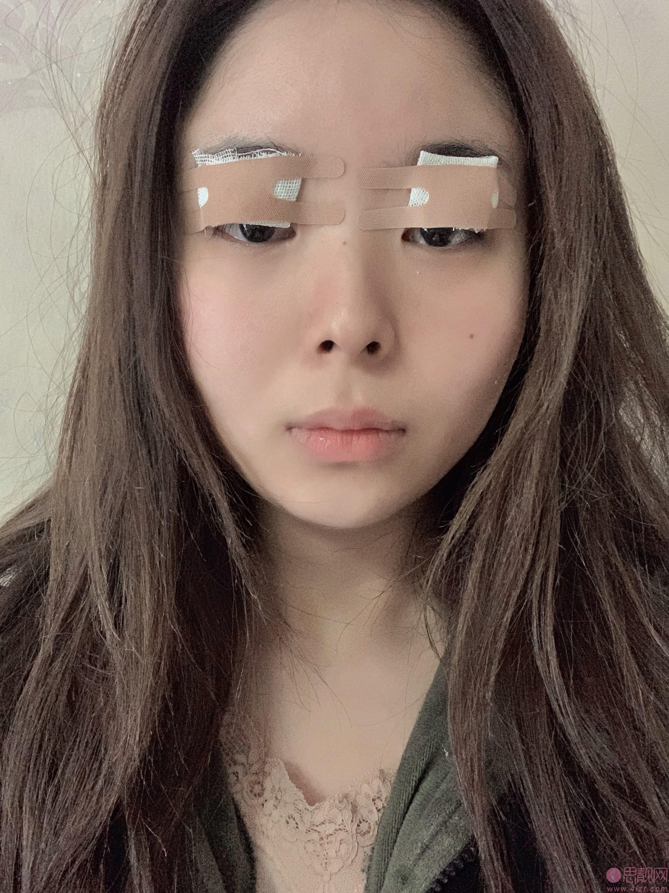 北京协和医院朱琳做双眼皮怎么样？