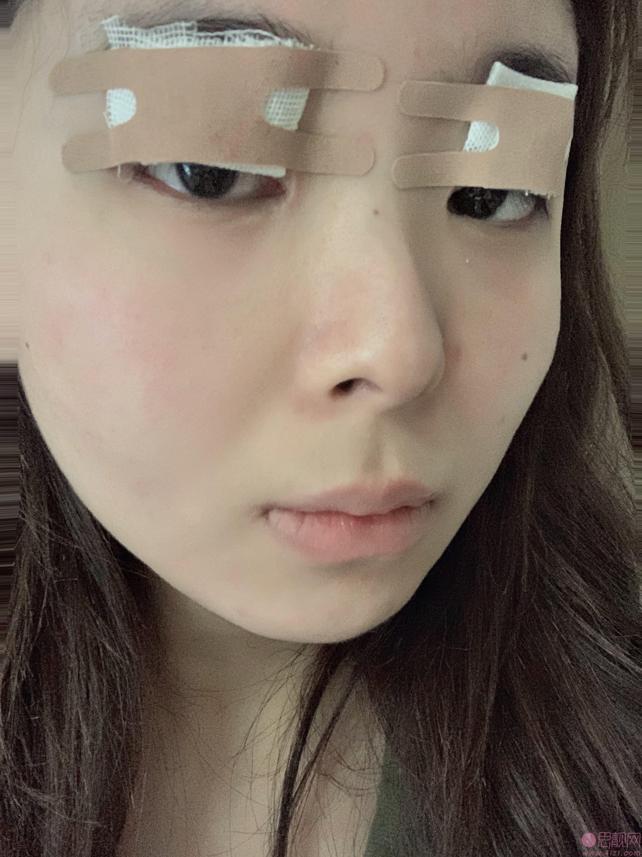 北京协和医院朱琳做双眼皮怎么样？