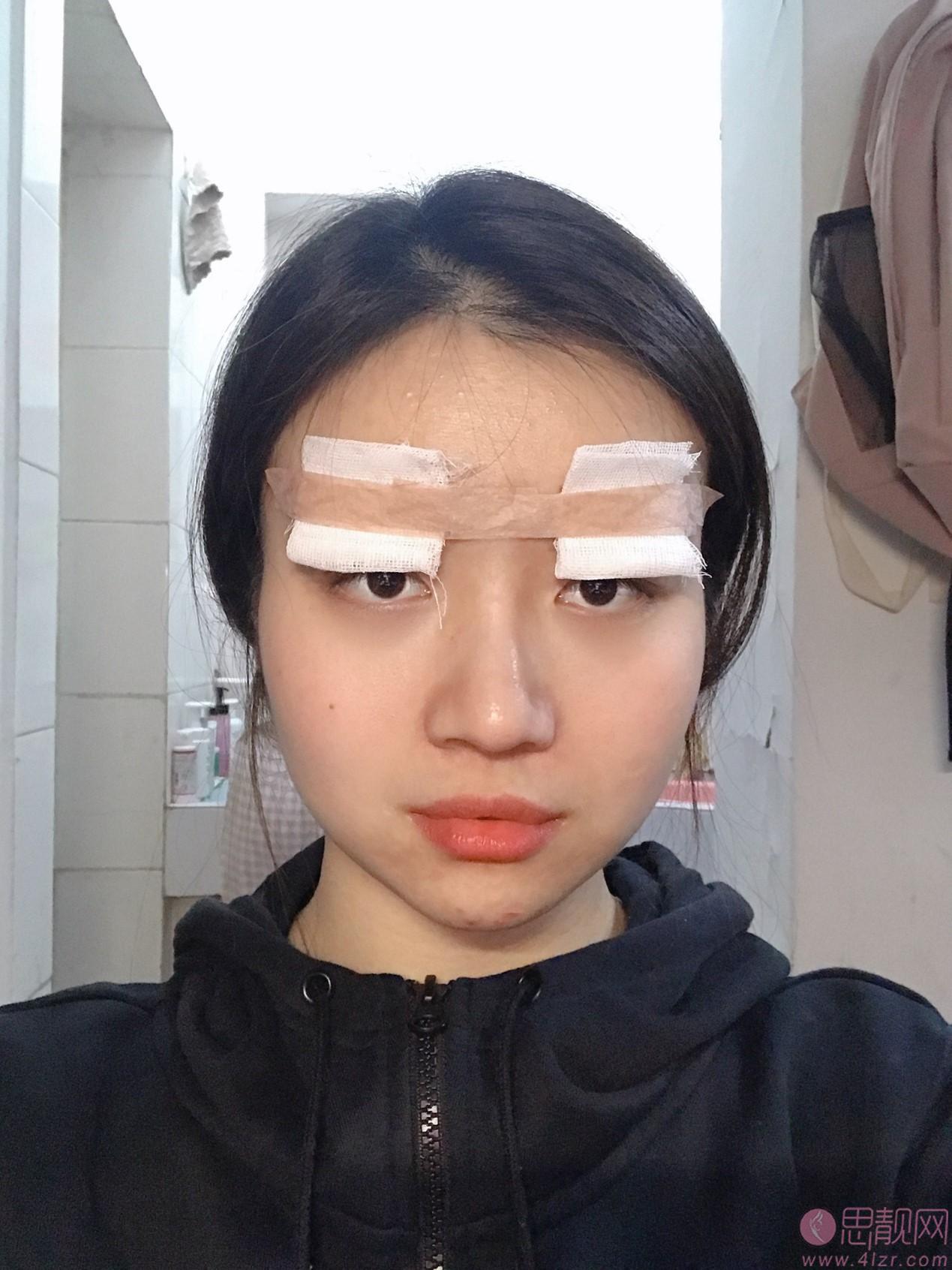 北京八大处陈光宇双眼皮做的怎么样？