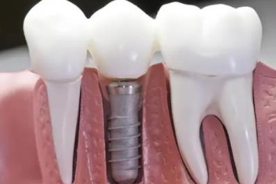 种植牙的过程是怎么样的？在医院做牙齿种植价格高不高？