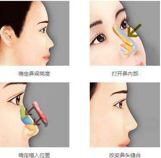 哪种隆鼻手术比较好?