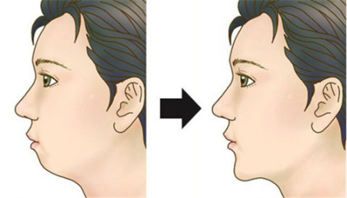 硅胶隆鼻能放一辈子吗，硅胶隆鼻有什么优势和缺点呢？硅胶隆鼻能够隆起鼻尖吗？