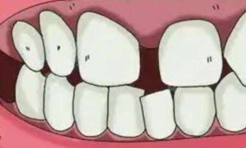 四环素牙怎么治，怎么选择去哪里？