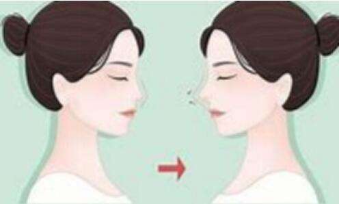 做胶原蛋白隆鼻的副作用有什么？常见的几个副作用分享